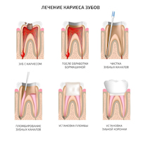 Звук лечения кариеса у стоматолога